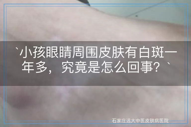 小孩眼睛周围皮肤有白斑一年多，究竟是怎么回事？
