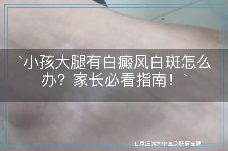 小孩大腿有白癜风白斑怎么办？家长必看指南！