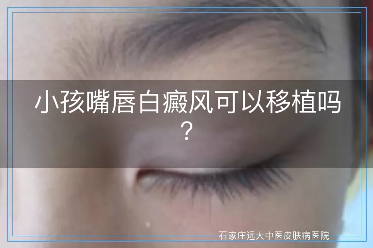 小孩嘴唇白癜风可以移植吗？