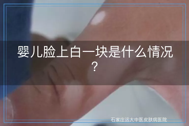 婴儿脸上白一块是什么情况？