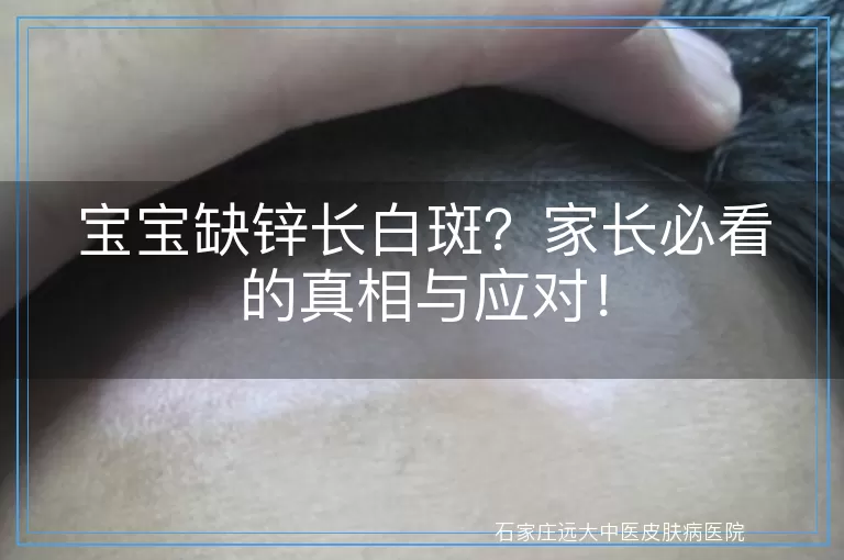 宝宝缺锌长白斑？家长必看的真相与应对！