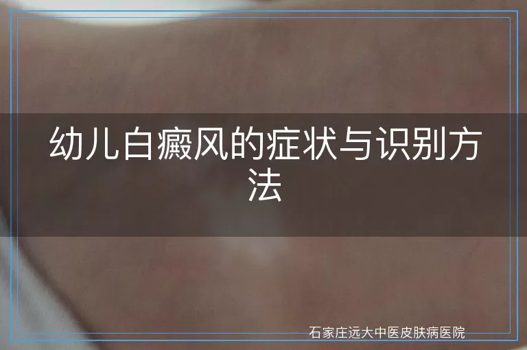 幼儿白癜风的症状与识别方法