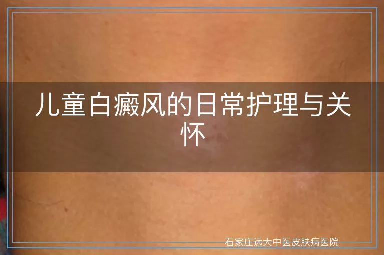儿童白癜风的日常护理与关怀