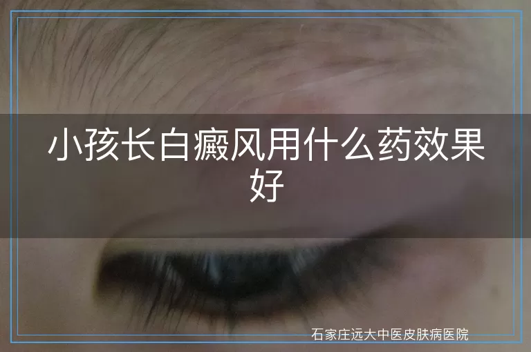 小孩长白癜风用什么药效果好