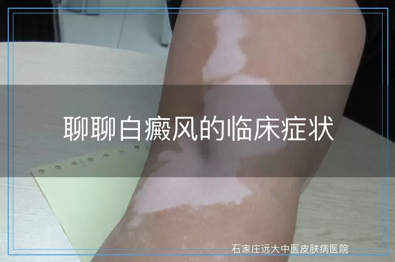 聊聊白癜风的临床症状