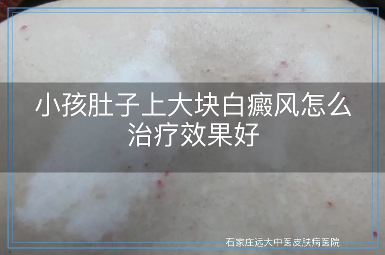 小孩肚子上大块白癜风怎么治疗效果好