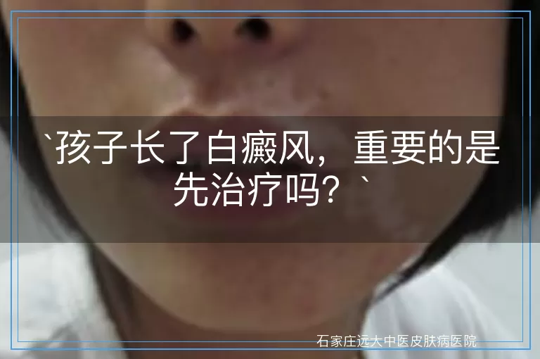 孩子长了白癜风，重要的是先治疗吗？