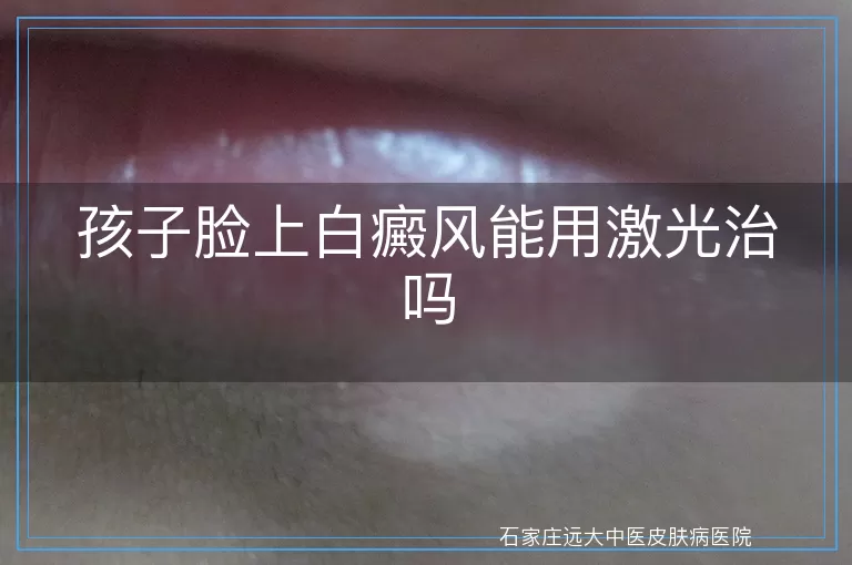 孩子脸上白癜风能用激光治吗