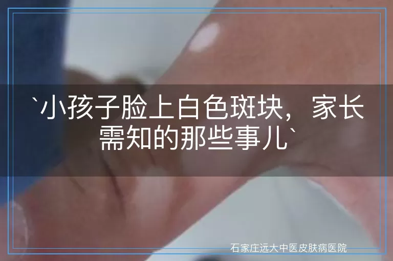 小孩子脸上白色斑块，家长需知的那些事儿