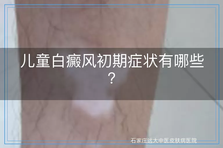 儿童白癜风初期症状有哪些？