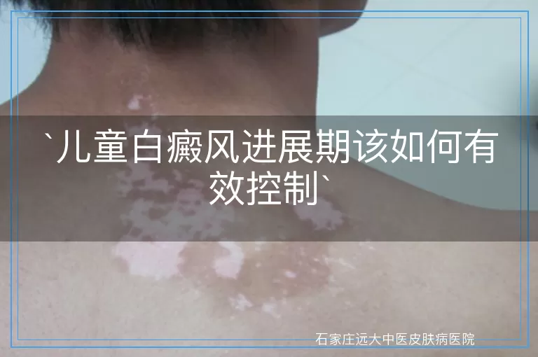 儿童白癜风进展期该如何有效控制