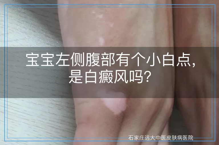 宝宝左侧腹部有个小白点，是白癜风吗？