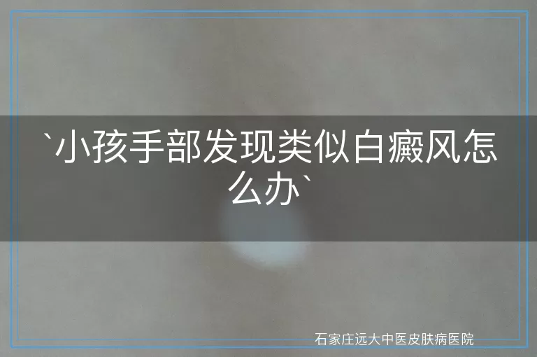 小孩手部发现类似白癜风怎么办
