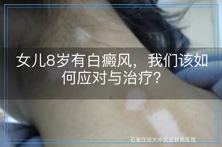 女儿8岁有白癜风，我们该如何应对与治疗？