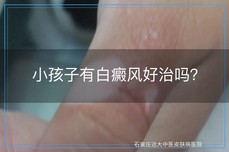 小孩子有白癜风好治吗？