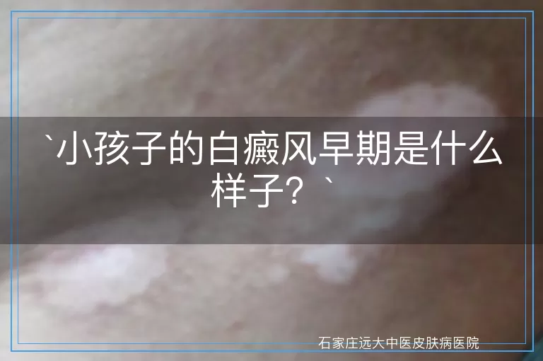 小孩子的白癜风早期是什么样子？