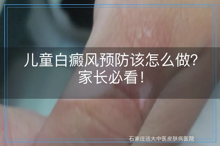 儿童白癜风预防该怎么做？家长必看！