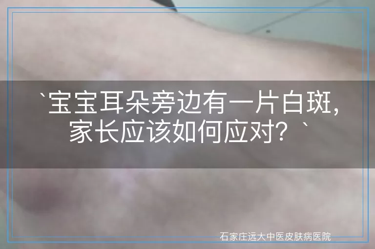 宝宝耳朵旁边有一片白斑,家长应该如何应对?