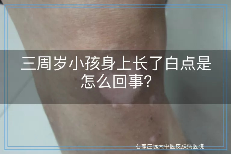 三周岁小孩身上长了白点是怎么回事?