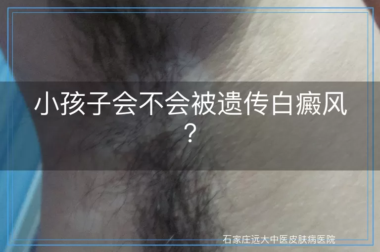 小孩子会不会被遗传白癜风？
