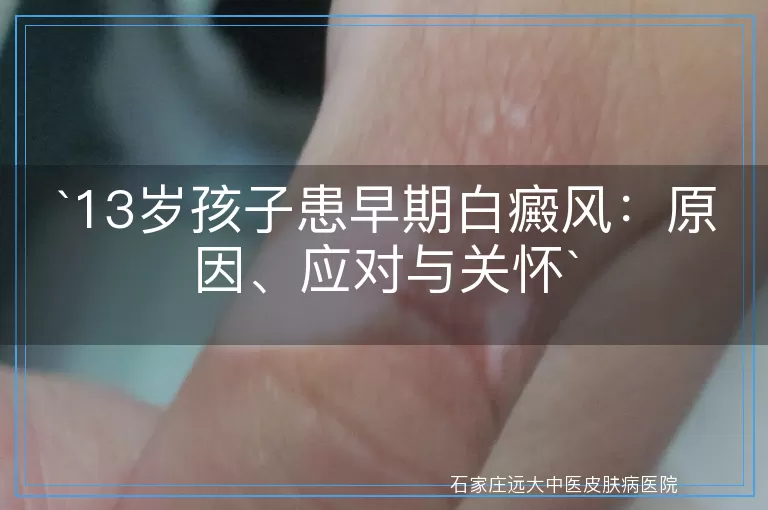 13岁孩子患早期白癜风：原因、应对与关怀