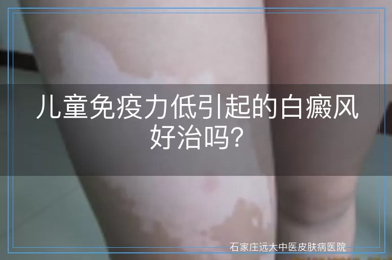 儿童免疫力低引起的白癜风好治吗？