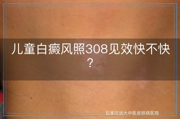 儿童白癜风照308见效快不快？