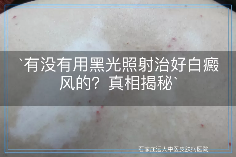 有没有用黑光照射治好白癜风的？真相揭秘