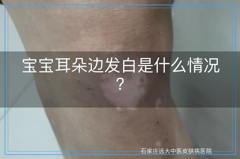 宝宝耳朵边发白是什么情况?