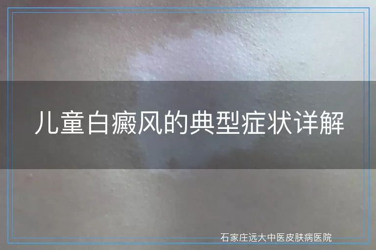 儿童白癜风的典型症状详解