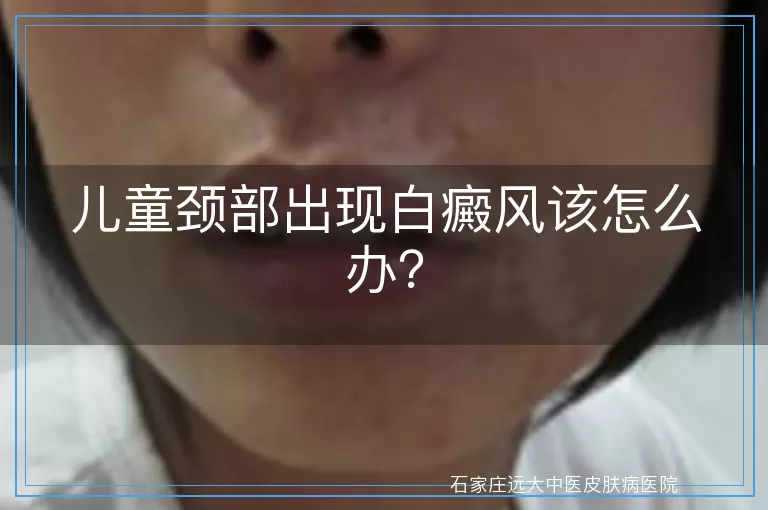 儿童颈部出现白癜风该怎么办？
