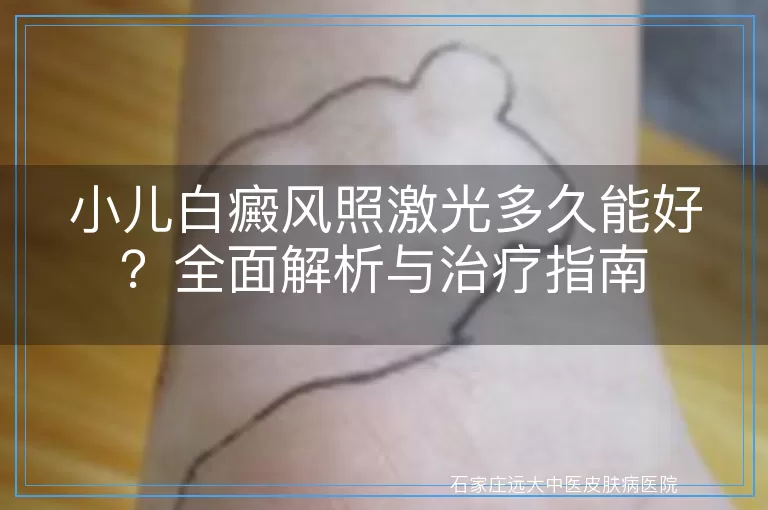 小儿白癜风照激光多久能好？全面解析与治疗指南