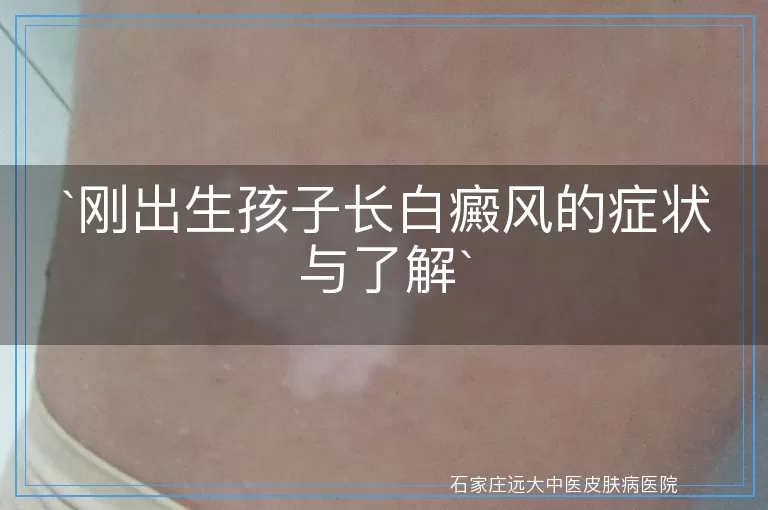 刚出生孩子长白癜风的症状与了解