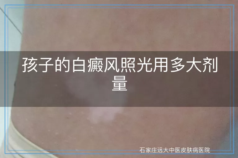 孩子的白癜风照光用多大剂量