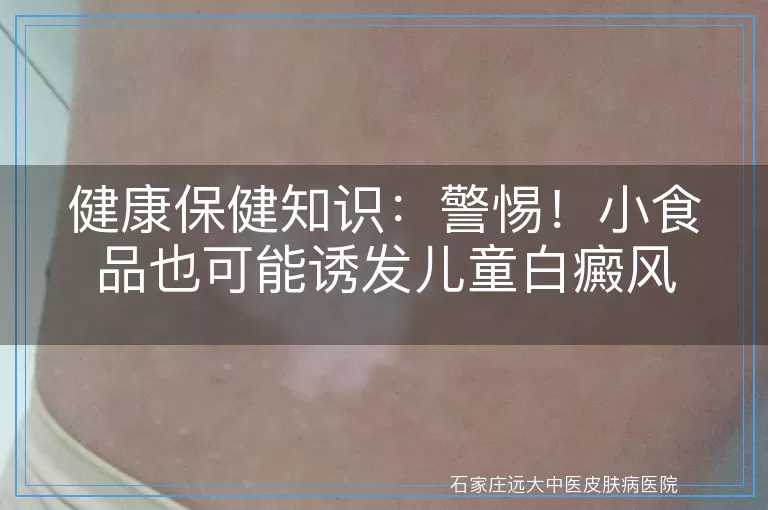 健康保健知识：警惕！小食品也可能诱发儿童白癜风