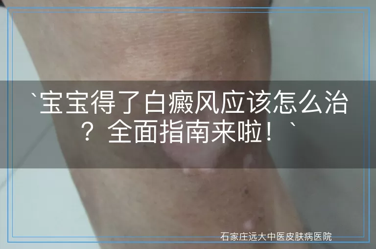 宝宝得了白癜风应该怎么治？全面指南来啦！