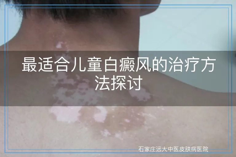 最适合儿童白癜风的治疗方法探讨