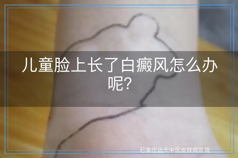 儿童脸上长了白癜风怎么办呢？