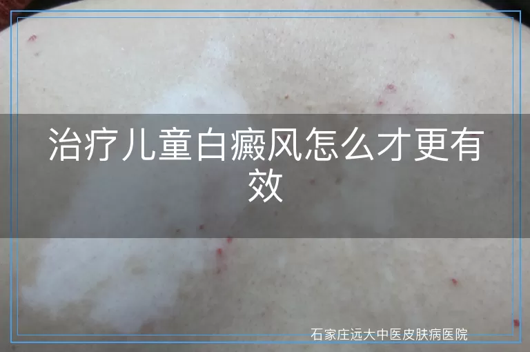 治疗儿童白癜风怎么才更有效