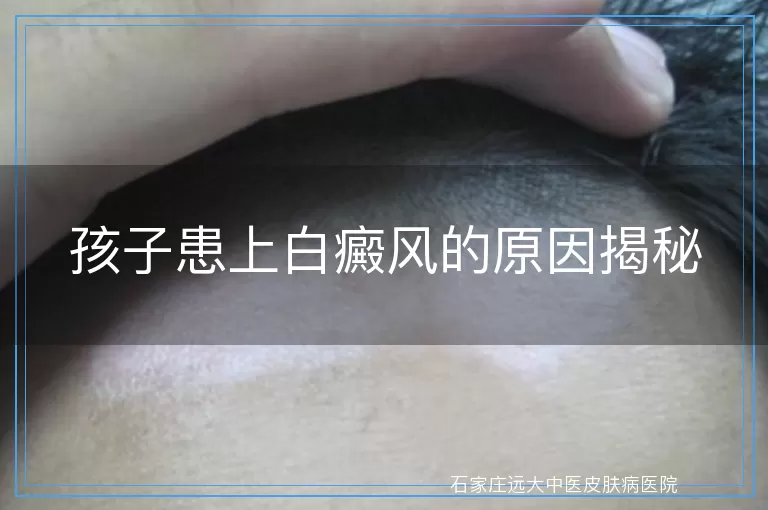 孩子患上白癜风的原因揭秘