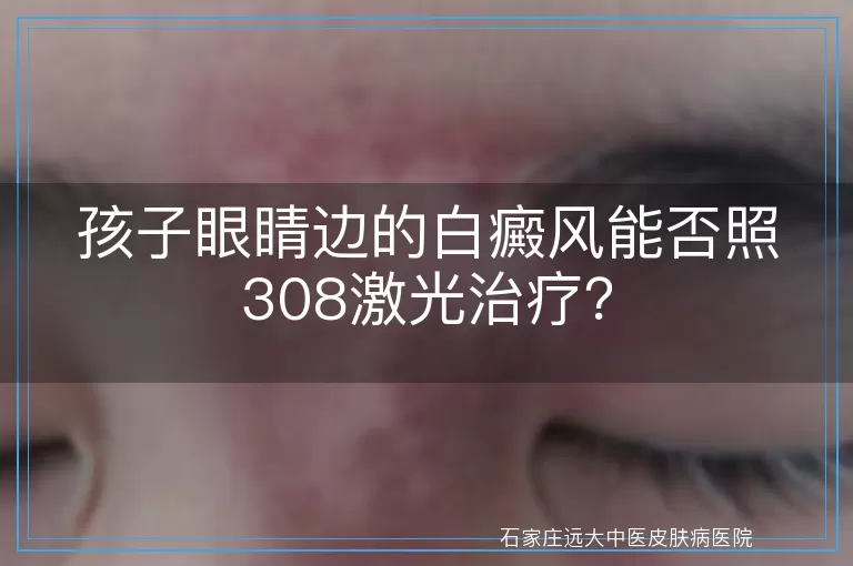 孩子眼睛边的白癜风能否照308激光治疗？