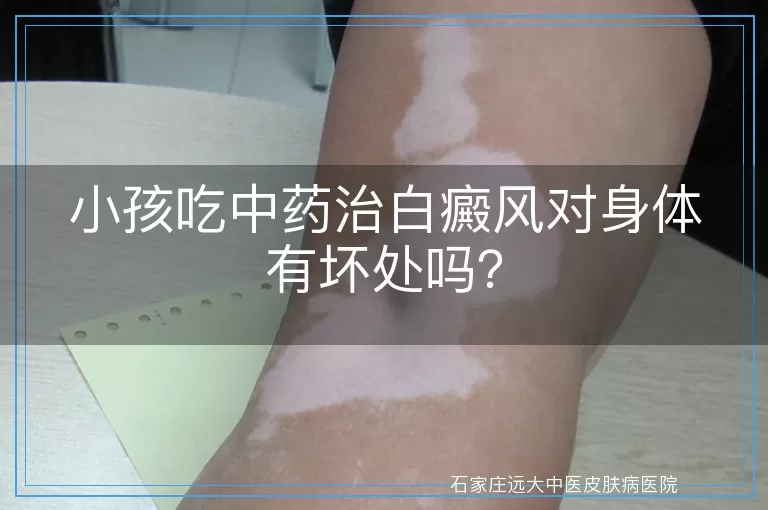 小孩吃中药治白癜风对身体有坏处吗？