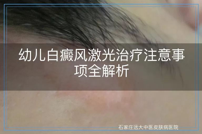 幼儿白癜风激光治疗注意事项全解析