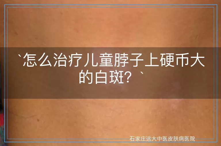 怎么治疗儿童脖子上硬币大的白斑？
