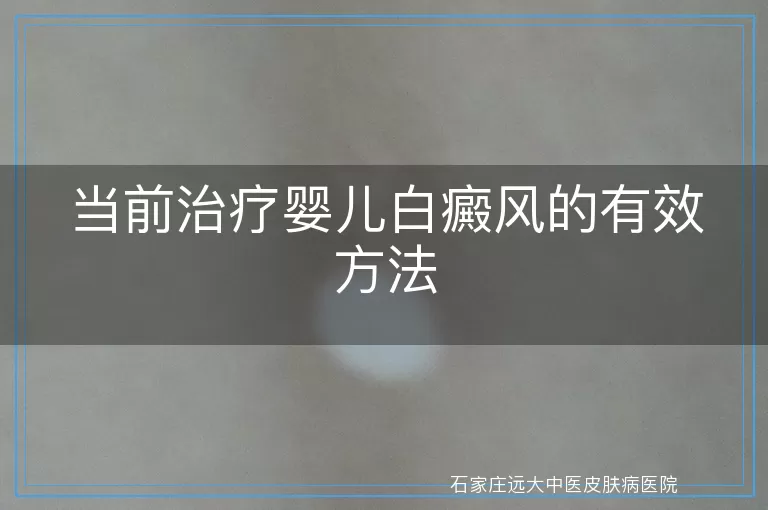 当前治疗婴儿白癜风的有效方法