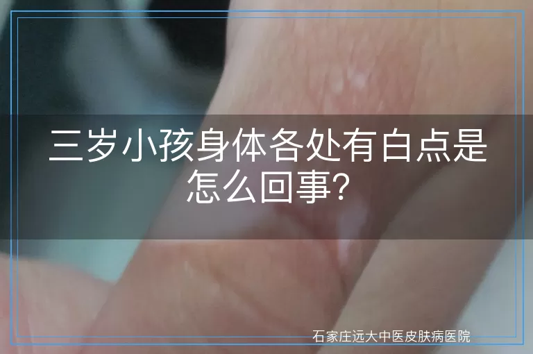 三岁小孩身体各处有白点是怎么回事?