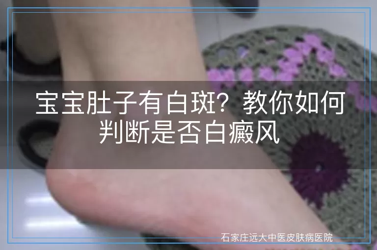 宝宝肚子有白斑？教你如何判断是否白癜风