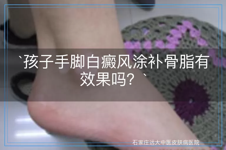 孩子手脚白癜风涂补骨脂有效果吗？
