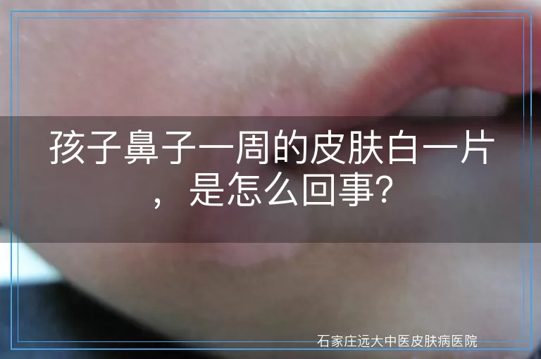 孩子鼻子一周的皮肤白一片，是怎么回事？