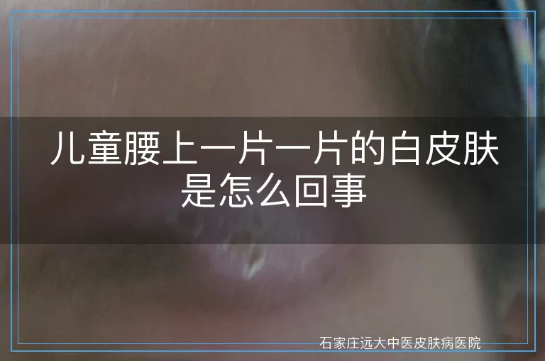 儿童腰上一片一片的白皮肤是怎么回事